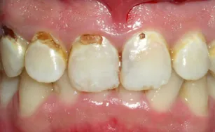 Patient smile before dental treatment at Gentle Smiles of Cherry Hill