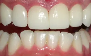 Patient smile after dental crowns and restoration at Gentle Smiles of Cherry Hill