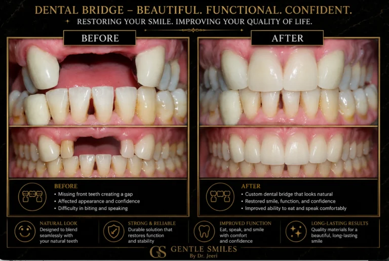 Dental bridge before and after restoring missing front teeth and smile function in Cherry Hill, NJ