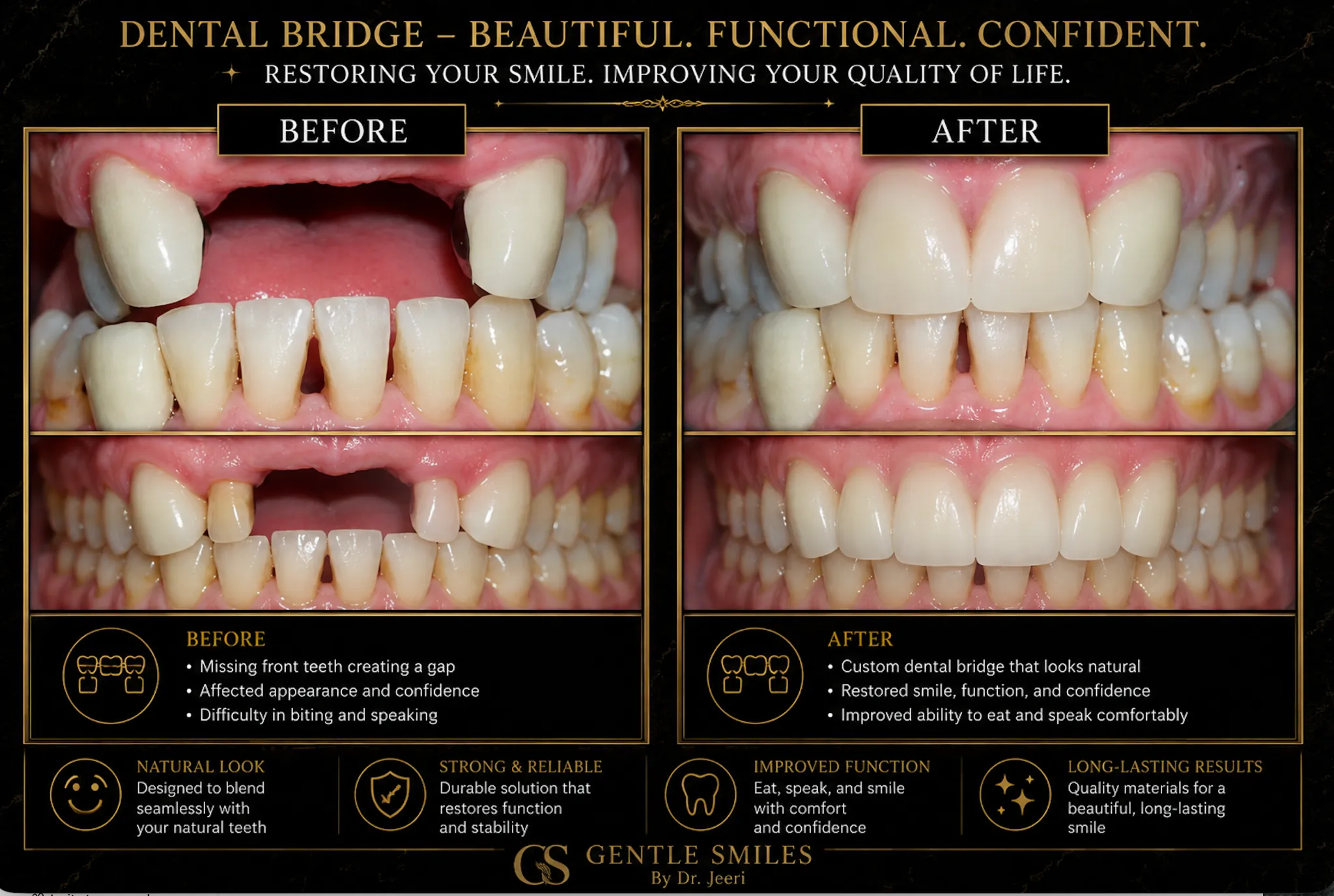 Dental bridge before and after at Gentle Smiles of Cherry Hill, NJ