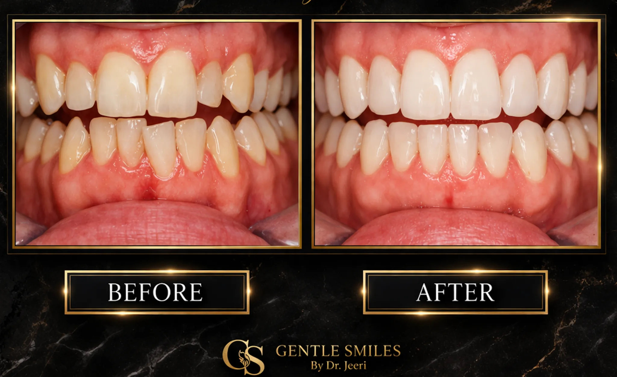Invisalign smile makeover before and after results at Gentle Smiles of Cherry Hill, NJ