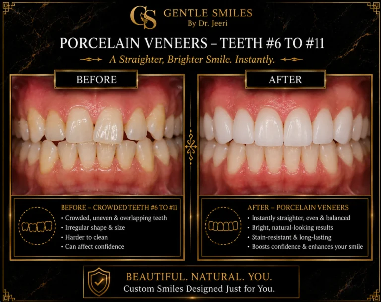 Porcelain veneers on teeth 6 to 11 before and after showing a straighter, brighter smile in Cherry Hill, NJ