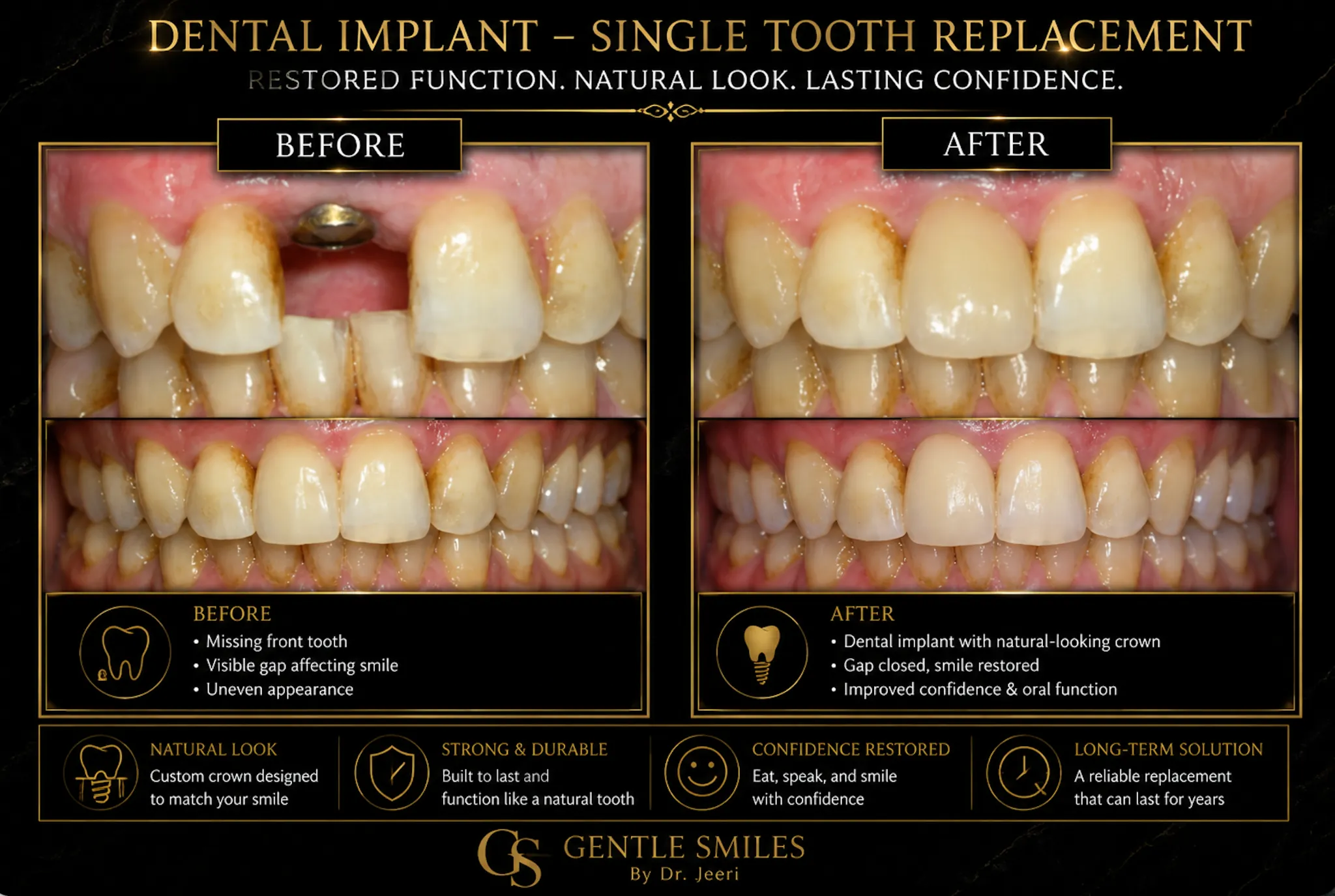 Single tooth dental implant before and after at Gentle Smiles of Cherry Hill, NJ
