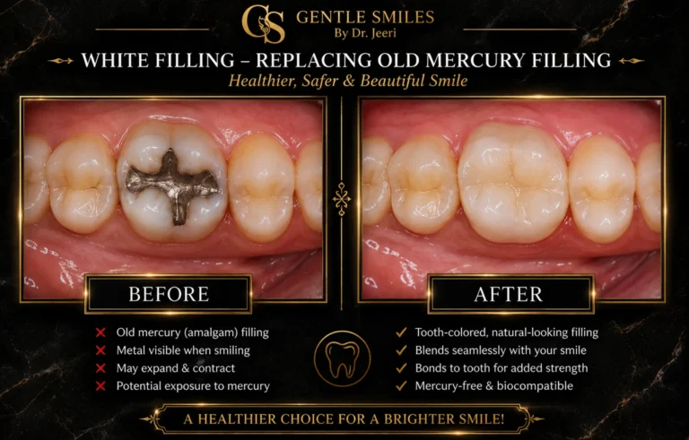 White filling before and after replacing an old mercury filling with a natural tooth-colored restoration in Cherry Hill, NJ