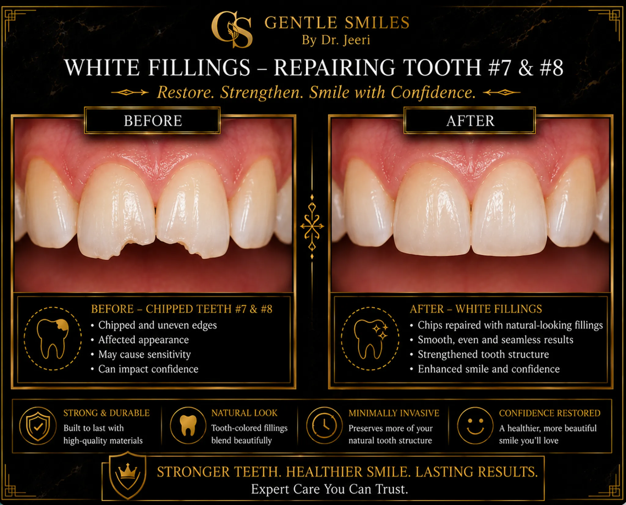 White fillings chipped front teeth repair before and after at Gentle Smiles of Cherry Hill, NJ