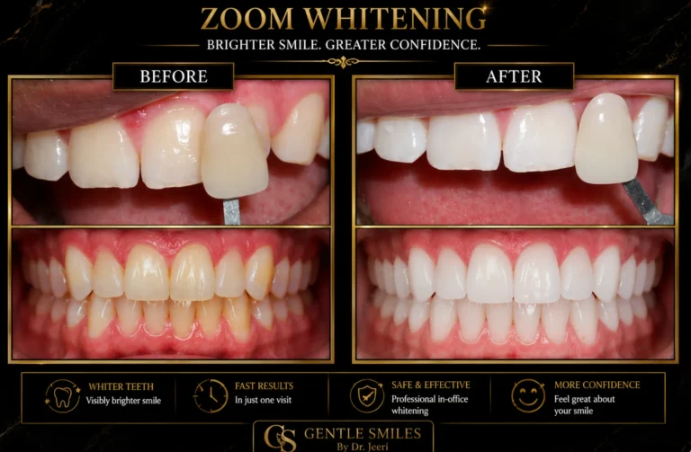 Zoom whitening before and after showing a brighter, whiter smile at Gentle Smiles of Cherry Hill, NJ