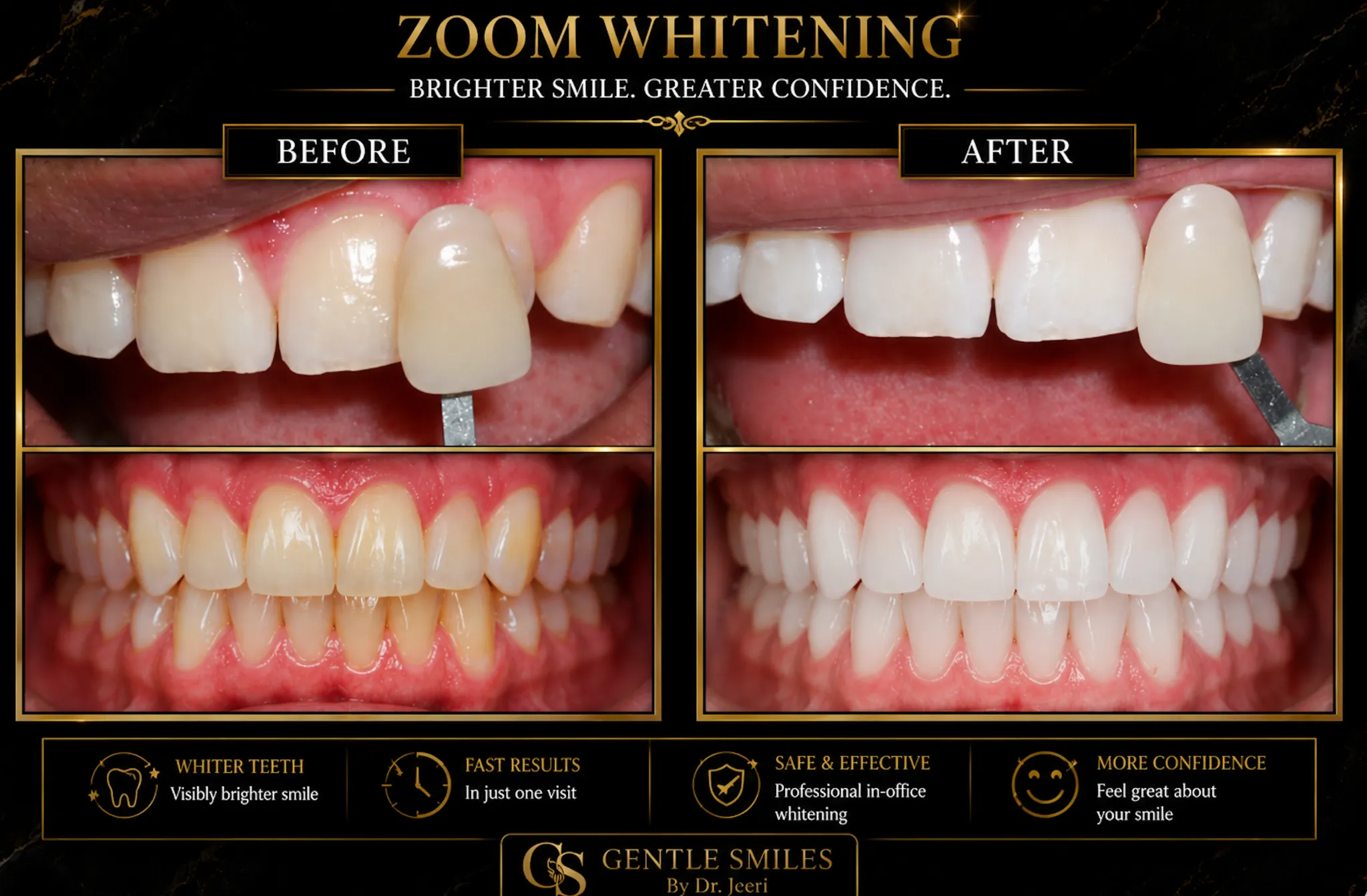 Zoom whitening before and after results at Gentle Smiles of Cherry Hill, NJ