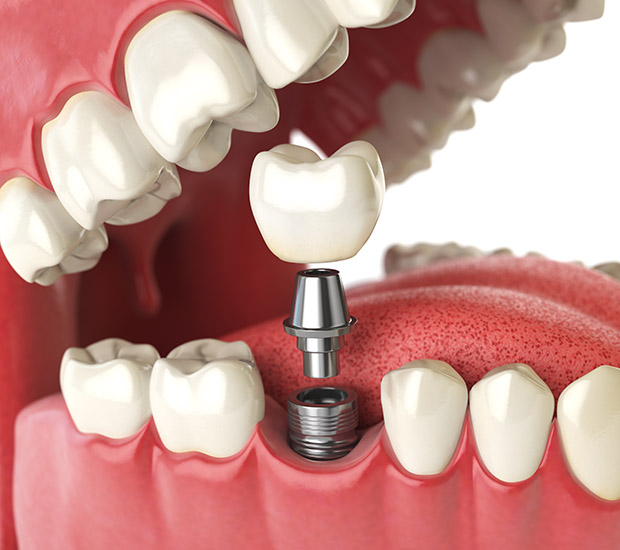 Cherry Hill Will I Need a Bone Graft for Dental Implants