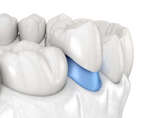 Does A Dental Crown Protect Your Tooth?